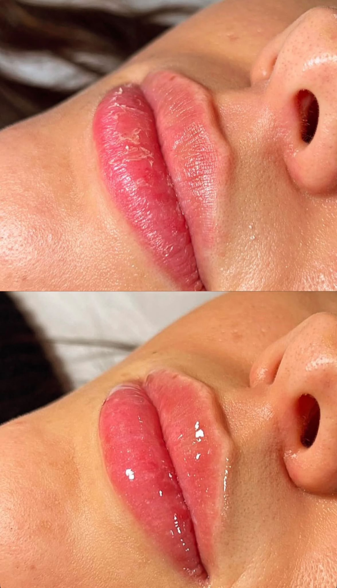 LIPS Z Treatment